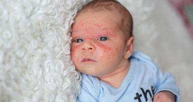 Hemangioamele la copii sunt localizate, în special, pe față sau scalp