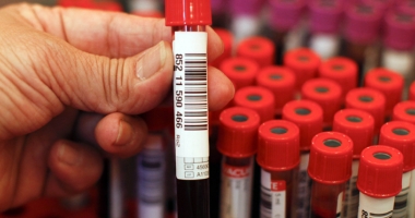 Stire din Sănătate : Hepatita poate fi tratată. Diagnosticare gratuită, la Medstar General Hospital