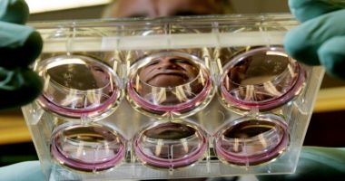 Stire din Actualitate : Bărbat vindecat de HIV după un transplant de măduvă osoasă
