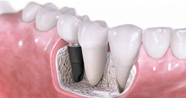 Părerile pacienților despre diverse tipuri de implant dentar: preț, durată, aspect - 2