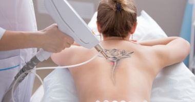 Stire din Sănătate : Tatuajele pot fi îndepărtate prin mai multe metode