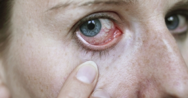 Stire din Sănătate : Infecțiile oculare necesită tratamente  de lungă durată