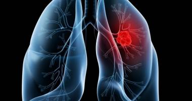 Stire din Sănătate : S-a descoperit alimentul ce ucide 85% din celulele cancerului pulmonar