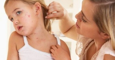 Stire din Cetățenești : Cum se evită cicatricile de la varicelă