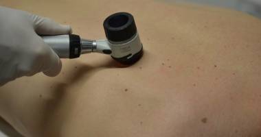Stire din Sănătate : Mergeți la medic cu alunițele! Cancerul de piele poate fi vindecat