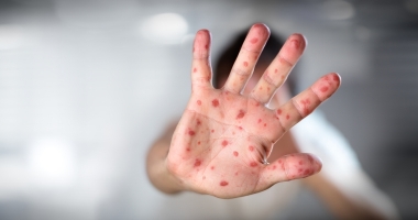 Încă un copil A MURIT DE RUJEOLĂ. Numărul deceselor a ajuns la 37