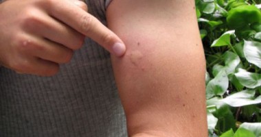 Stire din Sănătate : Cum tratăm înțepătura de țânțar