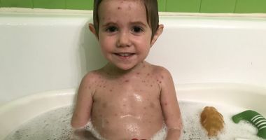 Stire din Social : Nu vă panicați! Medicii susțin că,  la Constanța, nu este epidemie de varicelă