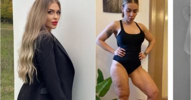 Stire din Actualitate : Oana Radu, înainte și după ce a slăbit. "Acestea sunt urmele pe care mâncarea le lăsase pe corpul meu"