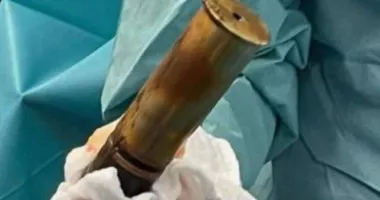 Stire din Actualitate : Un bărbat cu un obuz înfipt în rect a evacuat un spital întreg
