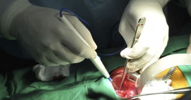 Stire din Sănătate : Constănțean salvat de chirurgi după ce i s-a rupt inima!