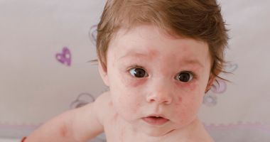 Stire din Sănătate : Protejați-vă copiii! Oreionul este mai des întâlnit iarna