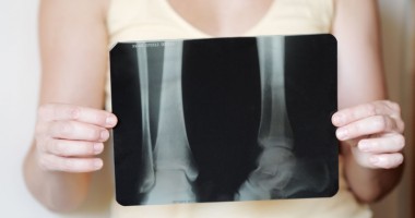 Stire din Sănătate : Osteoporoza, o boală răspândită  care trebuie să vă trimită la consultație