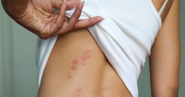 Constănțenii, disperați de atacul insectelor. Invazie de păianjeni, țânțari și purici, pe litoral - 2