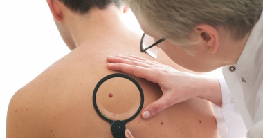 Cancerul de piele face ravagii