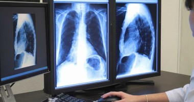 Stire din Sănătate : Bolnavii de cancer pulmonar au la dispoziție un ghid special