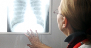 Stire din Sănătate : La ce complicații poate duce pneumonia netratată