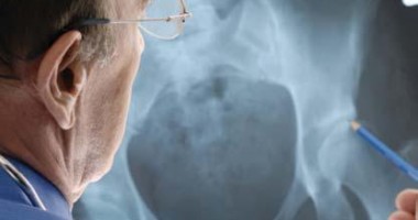 Stire din Cetățenești : Osteoporoza nu-i iartă nici pe bărbați!