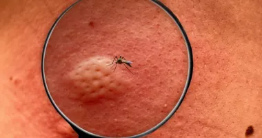 Stire din Actualitate : Alertă sanitară! România confirmă primul pacient cu virusul Chikungunya