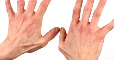 Psoriazisul amenință județul Constanța - 2