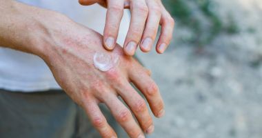 Stire din Sănătate : Psoriazisul apare și din cauza stresului sau a alcoolului în exces