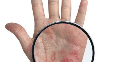 Stire din Sănătate : Stresul agravează simptomele psoriazisului şi creşte riscul de recidivă