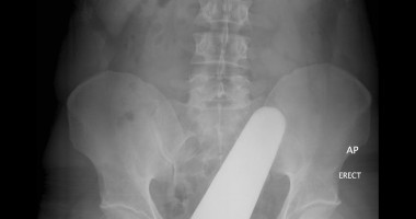 Stire din Sănătate : A ajuns la Urgență cu un spray blocat în anus