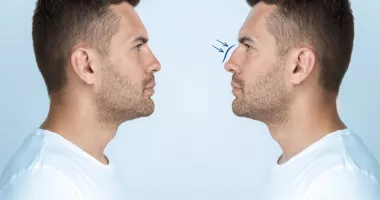 Foto - Vă gândiți la o rinoplastie? Ce ar trebui să știți înainte de operație