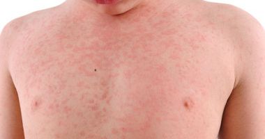 Stire din Social : Situație alarmantă în România: Peste 10.500 de cazuri de rujeolă. Care este situația la Constanța