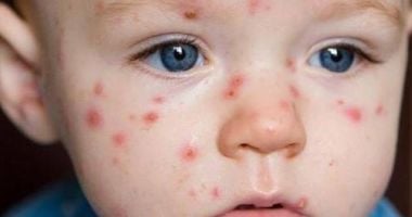 Stire din Sănătate : Epidemia uitată a României revine în forță