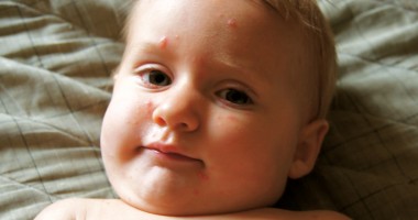 Cazurile de rujeolă din România au crescut îngrijorător de mult