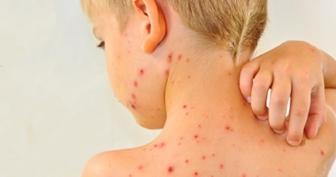 Cea mai mare epidemie de rujeolă din ultimii ani, înregistrată în România