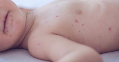Peste 80 de cazuri de rujeolă au fost confirmate în ultimele cinci zile