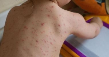 Stire din Sănătate : România sub amenințarea unei noi epidemii! Boala care face deja ravagii