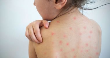 Stire din Social : Focar de rujeolă într-o comunitate de romi! 15 copii au ajuns la spital