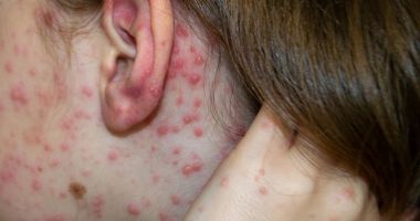 Stire din Social : O boală foarte contagioasă afectează Europa. România se confruntă cu cea mai mare epidemie
