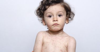 Stire din Sănătate : Rujeola poate provoca infecții ale urechii şi chiar convulsii
