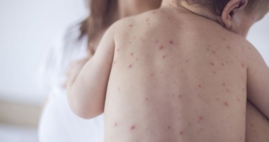 Stire din Sănătate : E JALE! INCĂ UN COPIL NAVACCINAT, UCIS DE RUJEOLĂ