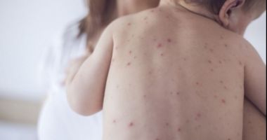 Alte 58 de cazuri nou confirmate de rujeolă au fost raportate