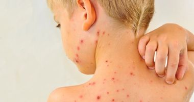 Epidemia de rujeolă se extinde