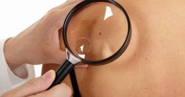 Stire din Sănătate : Cum scăpăm de negi în mod natural