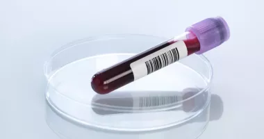 Stire din Sănătate : Sânge îngroșat? Ce opțiuni aveți pentru a preveni complicațiile periculoase