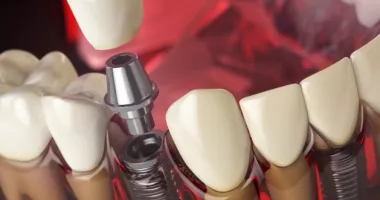 Stire din Actualitate : Bărbat găsit mort după depresie severă provocată de un tratament dentar eșuat în străinătate