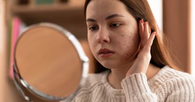 Stire din Sănătate : Excesul de sebum duce la probleme cu pielea, acnee și pori blocați