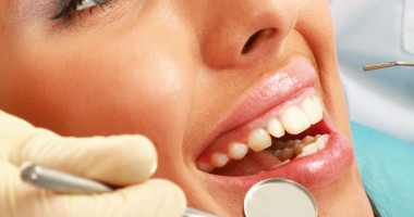 Stire din Sănătate : Care sunt beneficiile fațetelor dentare