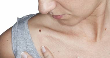 Stire din Sănătate : Care este principala cauză pentru cancerul de piele