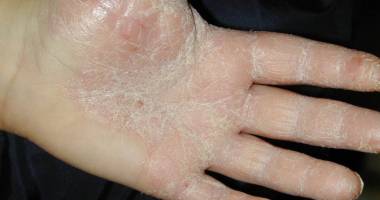 Stire din Sănătate : Stresul agravează simptomele psoriazisului  și crește riscul  de recidivă