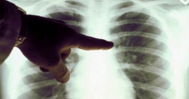 Stire din Social : Profesoară diagnosticată cu TBC. Peste 150 de elevi, testați medical pentru tuberculoză