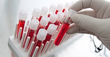 Un test special poate diagnostica, rapid, tuberculoza