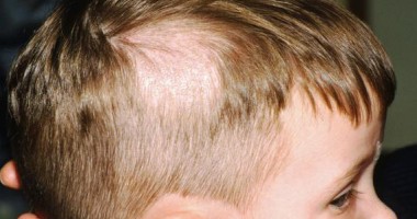 Pecinginea, infecție a scalpului și părului